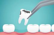 Tooth Removal and Extraction – My Gentle Dentist Arana Hills