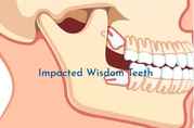 Wisdom Tooth Removal Brisbane - My Gentle Dentist