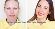 Cosmetic Dental Crown Procedure – Cosmetic Treatment