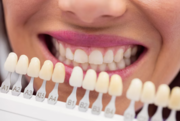 Transform Your Smile with Veneers in Brisbane 